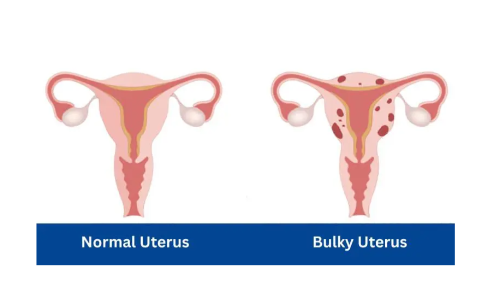 Bulky Uterus