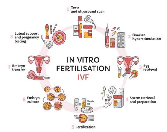 IVF procedure