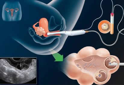 Purpose of In Vitro Fertilization