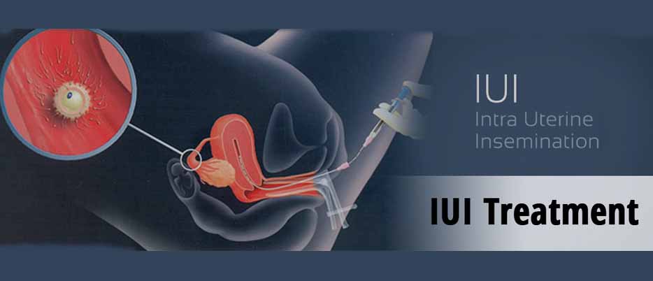 Intrauterine Insemination