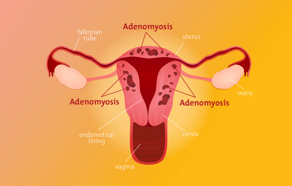 Adenomyosis